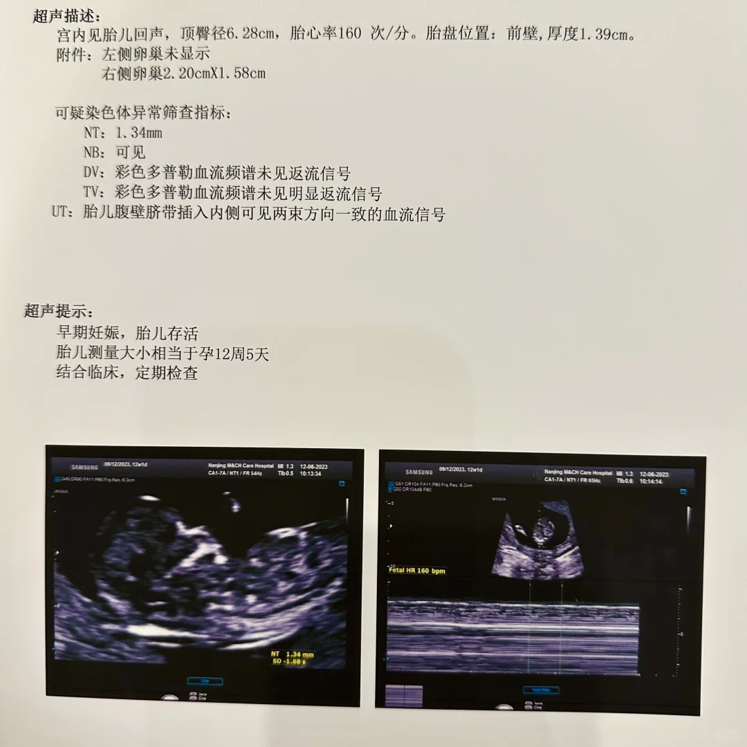 NT稳稳过啦,三代试管代孕选择性别